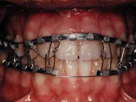 Jaw Fracture Treatment OroDentals