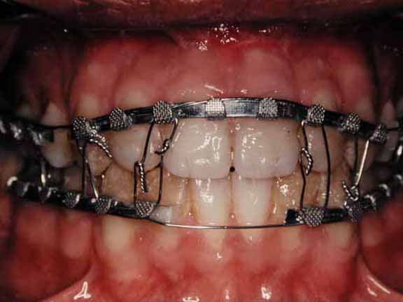 jaw-fracture-treatment-orodentals